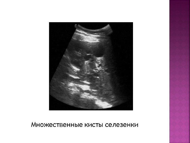 Множественные кисты селезенки